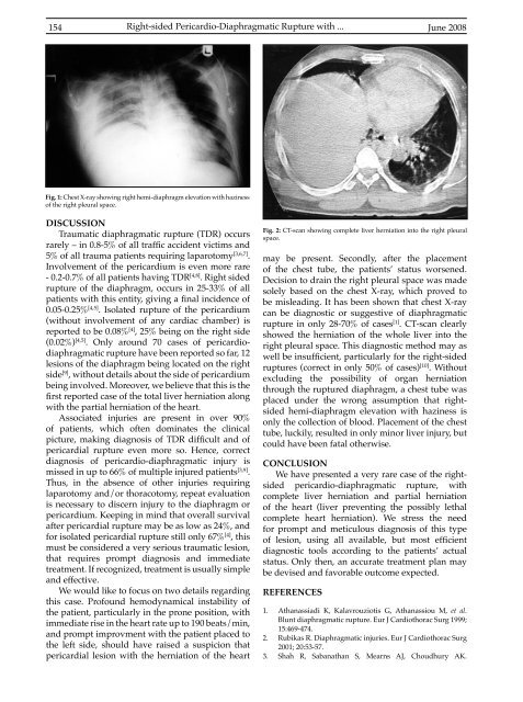 098-006 Right sided Pericardio.pdf