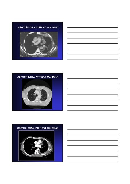 Mesotelioma diffuso maligno - Facoltà di Medicina e Chirurgia ...