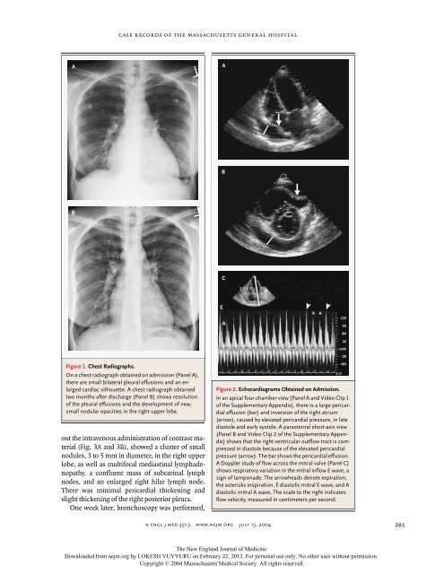 Case 22-2004: A 30-Year-Old Woman with a Pericardial Effusion