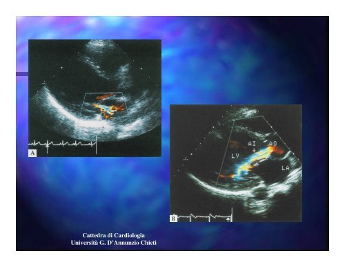 PERICARDITI ed ENDOCARDITI - Università Gabriele d'Annunzio