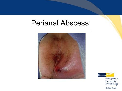 Perianal Crohn's Disease - Washington Hospital Center