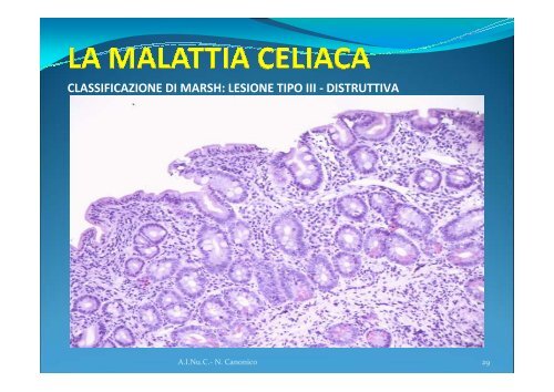 DIAGNOSI DI MALATTIA CELIACA