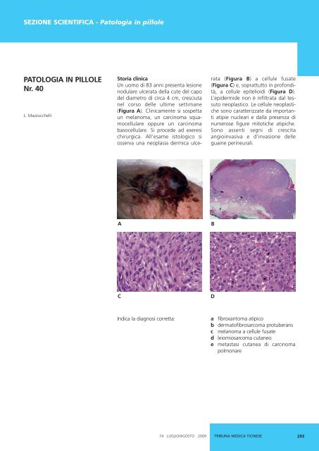 Fibroxantoma atipico