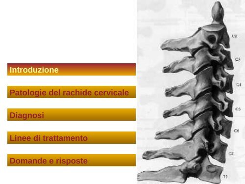 Ernia del disco cervicale - NeurologiaChirurgica.it