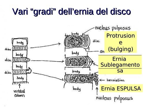 Ernia del disco cervicale - NeurologiaChirurgica.it