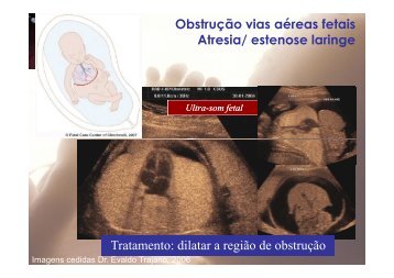 Obstrução vias aéreas fetais Atresia/ estenose laringe Tratamento ...