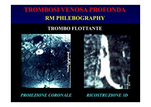 trombosi venosa profonda - Fisiokinesiterapia.biz