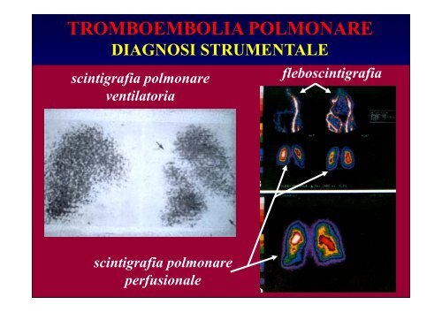 trombosi venosa profonda - Fisiokinesiterapia.biz