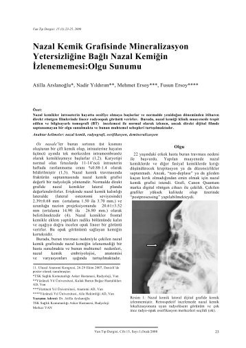 Nazal Kemik Grafisinde Mineralizasyon Yetersizliğine Bağlı Nazal ...