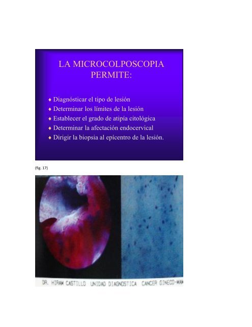 microcolpohisteroscopia, tecnica para el diagnostico temprano del ...