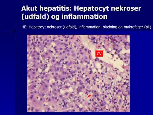 Hepatitis