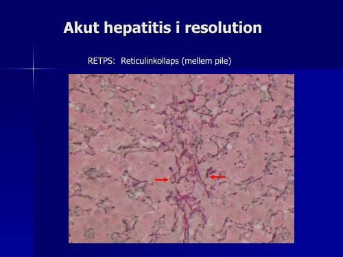 Hepatitis