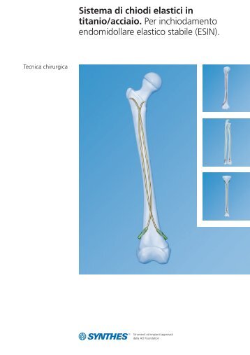 Sistema di chiodi elastici in titanio/acciaio Tecnica - Synthes