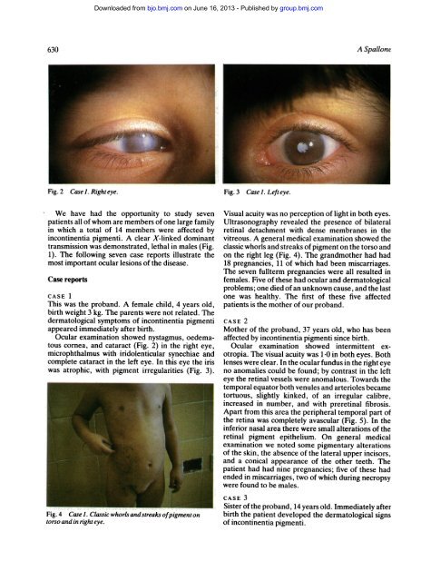 Incontinentia pigmenti - British Journal of Ophthalmology