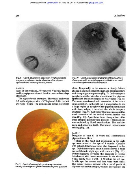 Incontinentia pigmenti - British Journal of Ophthalmology