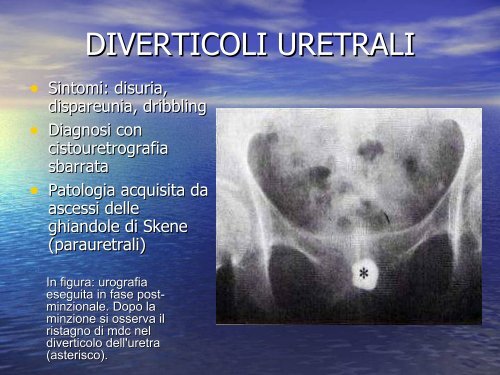 dribbling e minzione frequente dribbling e minzione frequente