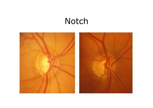 neuroretin