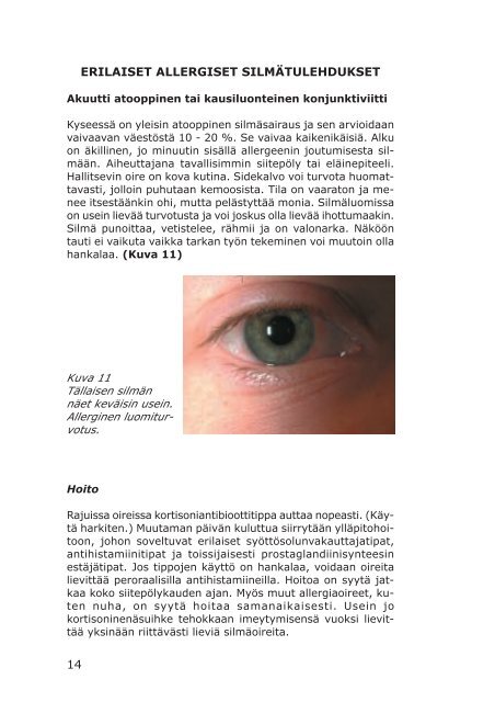 Lataa itsellesi Allergiset silmäsairaudet PDF-muodossa - Optokari Oy