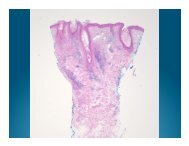 Discoid Lupus Erythematosus-2.pptx - DermpathMD.com