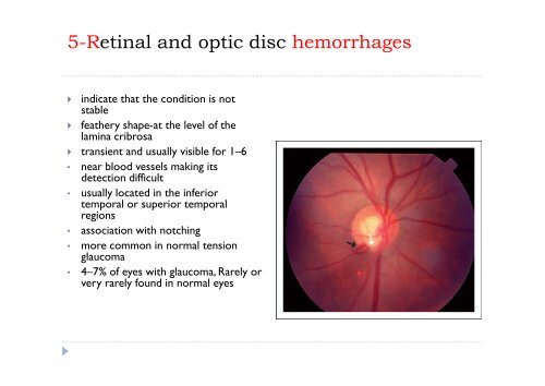Evaluation of optic disc in glaucoma