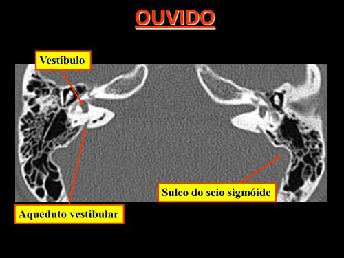 OSSOS TEMPORAIS(OUVIDO) - Comunidades