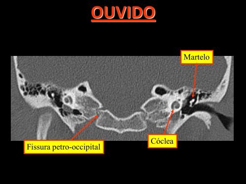 OSSOS TEMPORAIS(OUVIDO) - Comunidades