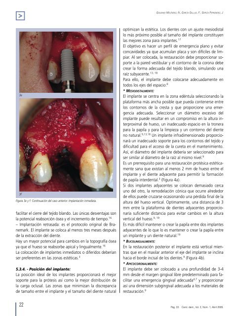 Estética de los tejidos blandos periimplantarios. - COEM