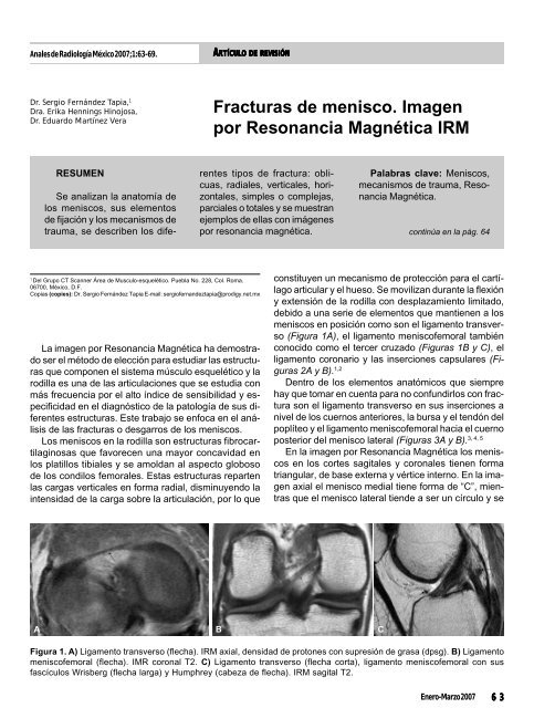 Fracturas de menisco. Imagen por Resonancia ... - edigraphic.com