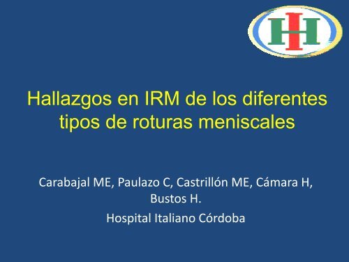 Hallazgos en IRM de los diferentes tipos de roturas meniscales