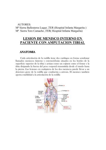 lesion de menisco interno en paciente con amputacion tibial