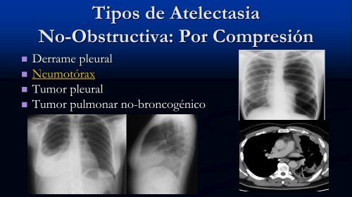 Tipos de Atelectasia No-Obstructiva