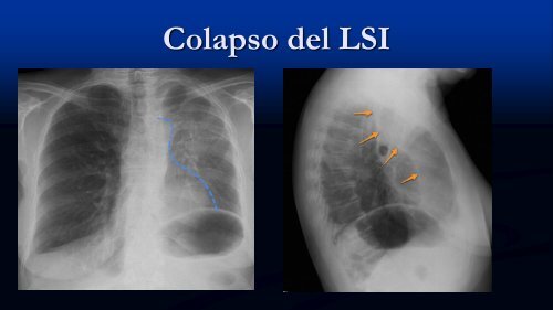 Tipos de Atelectasia No-Obstructiva