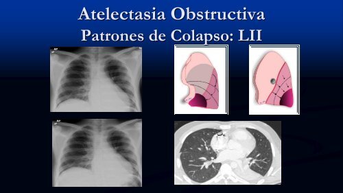 Tipos de Atelectasia No-Obstructiva