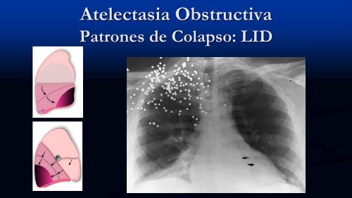 Tipos de Atelectasia No-Obstructiva