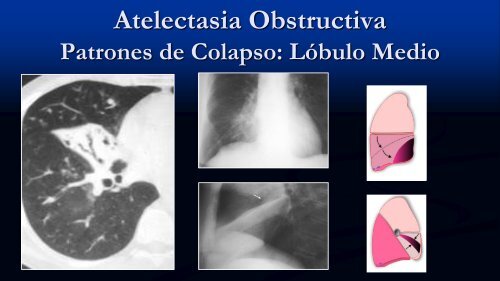 Tipos de Atelectasia No-Obstructiva