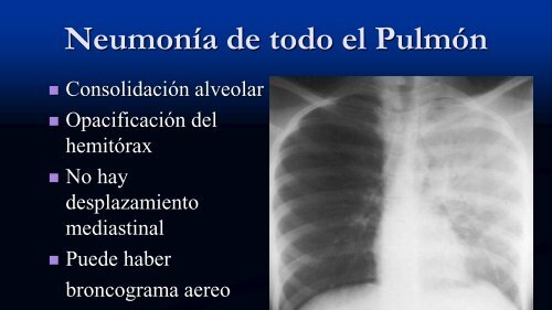 Tipos de Atelectasia No-Obstructiva