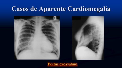 Tipos de Atelectasia No-Obstructiva