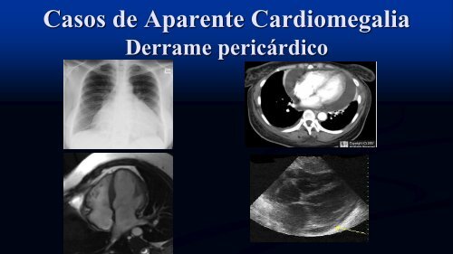 Tipos de Atelectasia No-Obstructiva