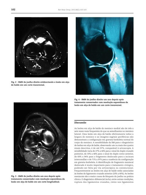 Resolução espontânea da lesão alça de balde do menisco ... - RBO