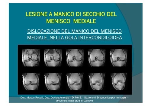 lesione a manico di secchio del menisco mediale - Sezione di ...