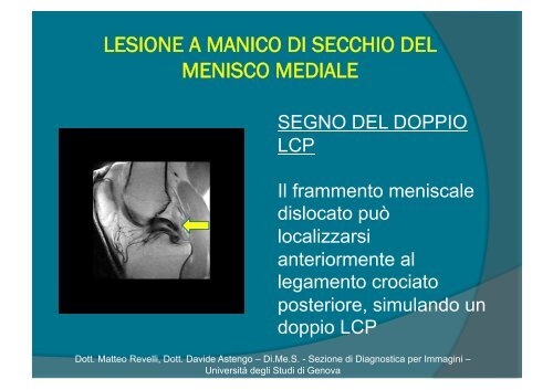 lesione a manico di secchio del menisco mediale - Sezione di ...