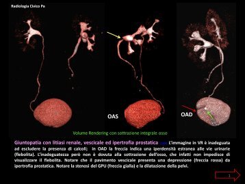Giuntopatia con litiasi renale, vescicale ed ipertrofia prostatica (117 ...