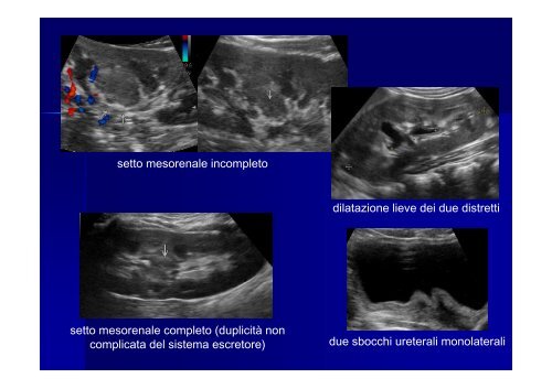 Il ruolo dell'ecografia nella gestione delle uropatie malformative - Fimp