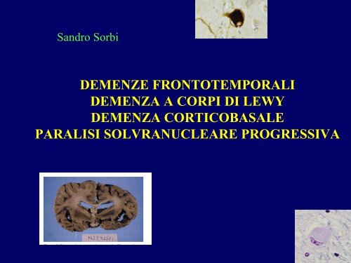 Demenze temporali - Demenza a corpi di Lewy - E-learning