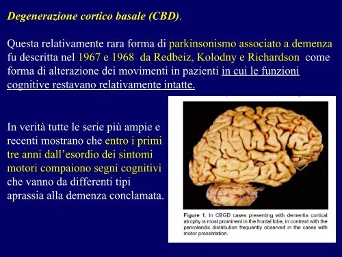 Demenze temporali - Demenza a corpi di Lewy - E-learning