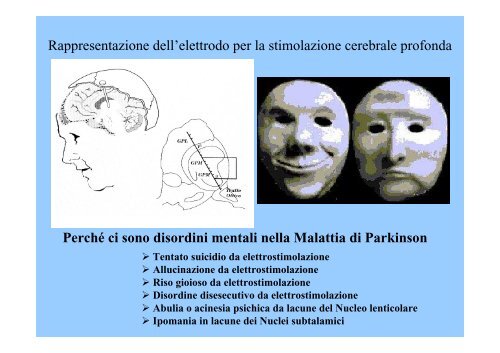 La demenza nel Parkinson e nei Parkinsonismi - Onofrj, Marco