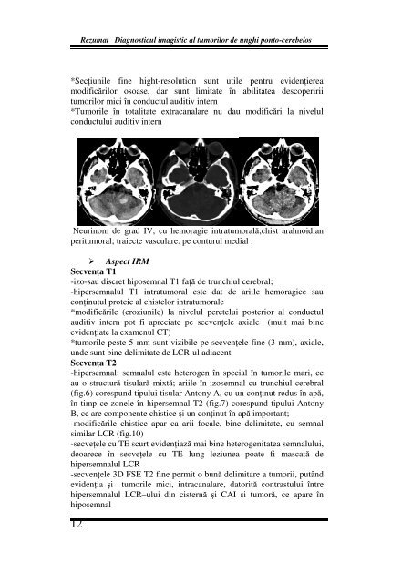 Diagnosticul imagistic al tumorilor de unghi ponto-cerebelos