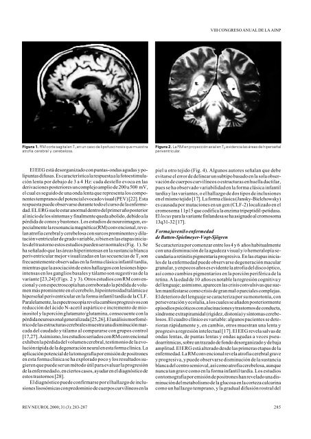 Aspectos neurológicos de la ceroidolipofuscinosis. - FEDAES