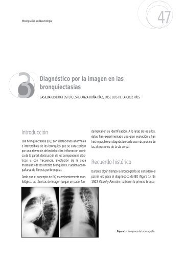 3 Diagnóstico por la imagen en las bronquiectasias - Neumología y ...