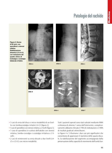 Instabilità del rachide: - Chirurgia vertebrale